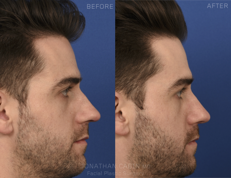 Jonathan Cabin MD Before & Afters